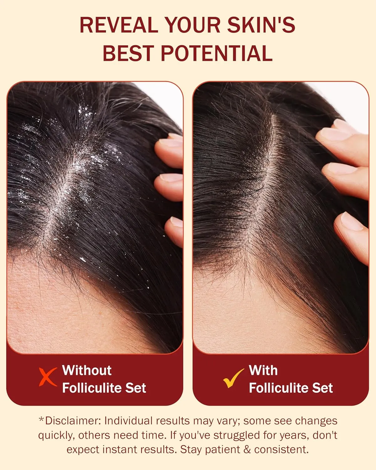 3% BHA Folliculitis Shampoo - Clarifying Shampoo with Salicylic Acid, Tea Tree Oil & Chamomile Extracts - Ideal for Flaky, Irritated & Dry Itchy Scalp, 8 fl. oz